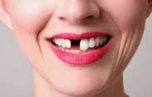 Tafsir Mimpi Lihat Orang Gigi Palsu Nya Copot Berdasarkan Primbon Jawa Dan  Menurut Islam