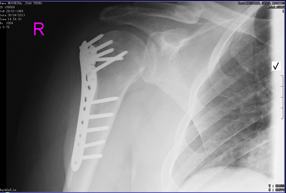 RX Fratura Extremidade Proximal Umero