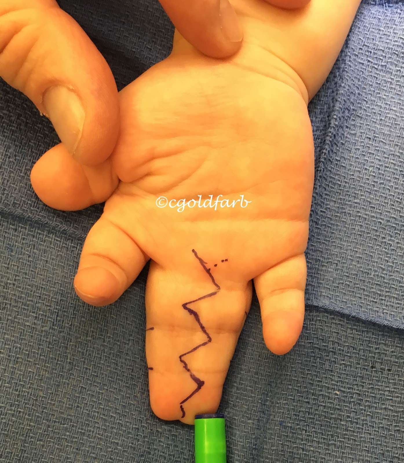 Congenital Hand and Arm Differences