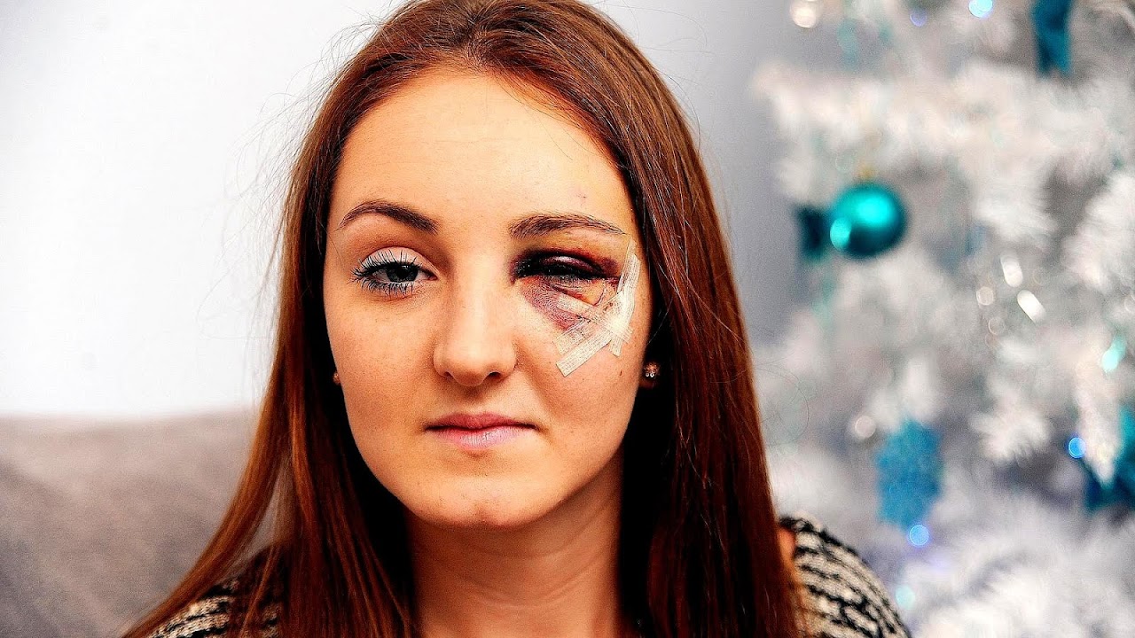 Broken Eye Socket Treatment Sock Choices