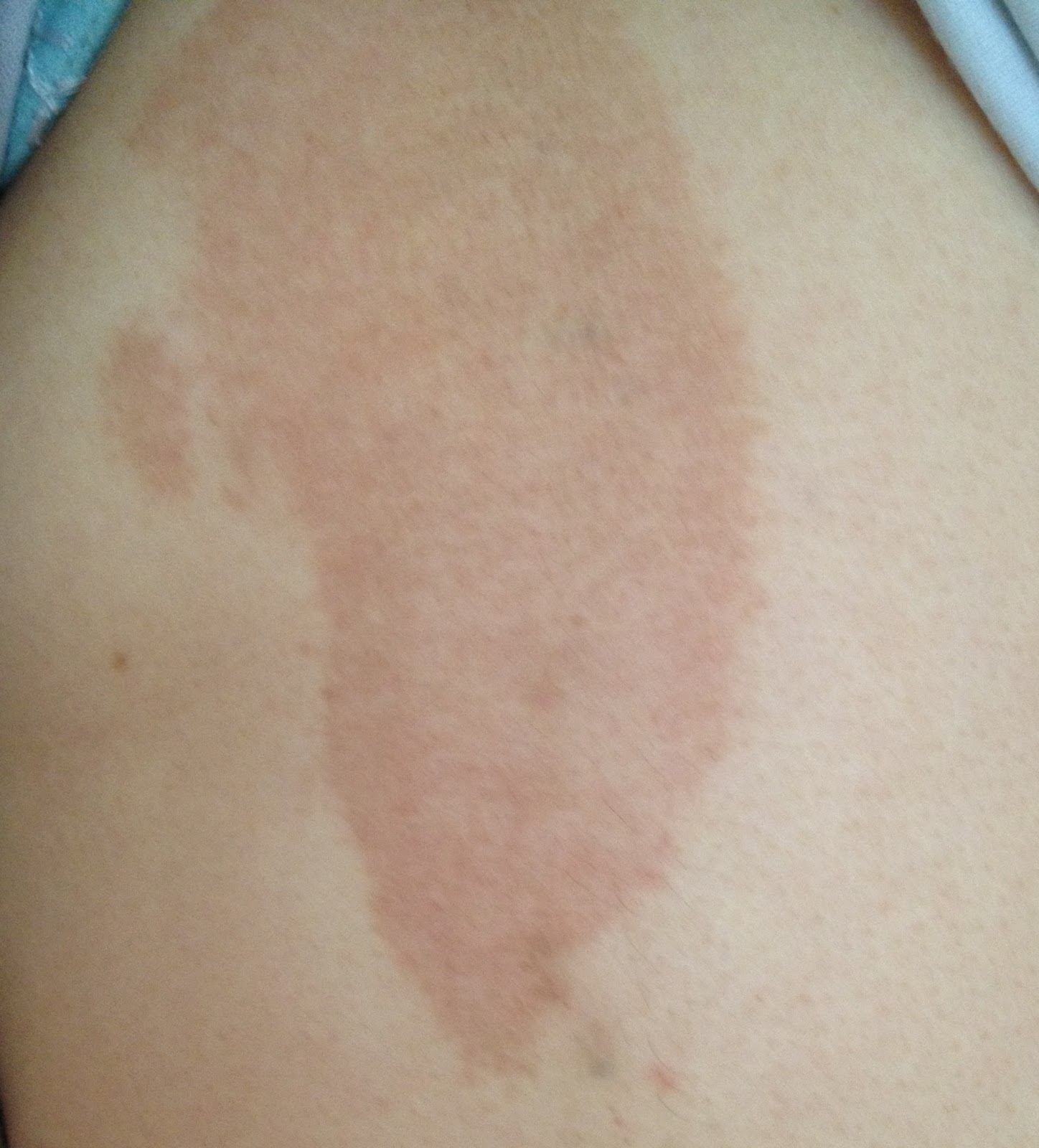 Palmer's cocoa butter. See it used on me! Do not read post if sensitive