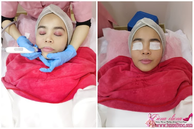 PENGALAMAN  RAWATAN MICRODERMABRASION DAN WHITENING PEEL DI KLINIK DR. BAZILAH