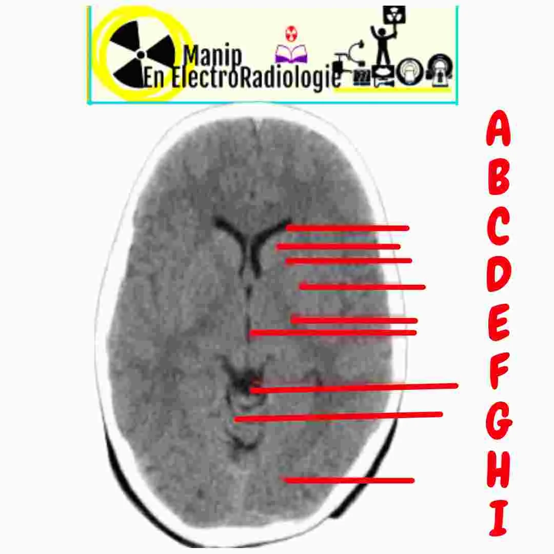 Structures anatomiques du tdm cérébral normal au niveau des ganglions de la base