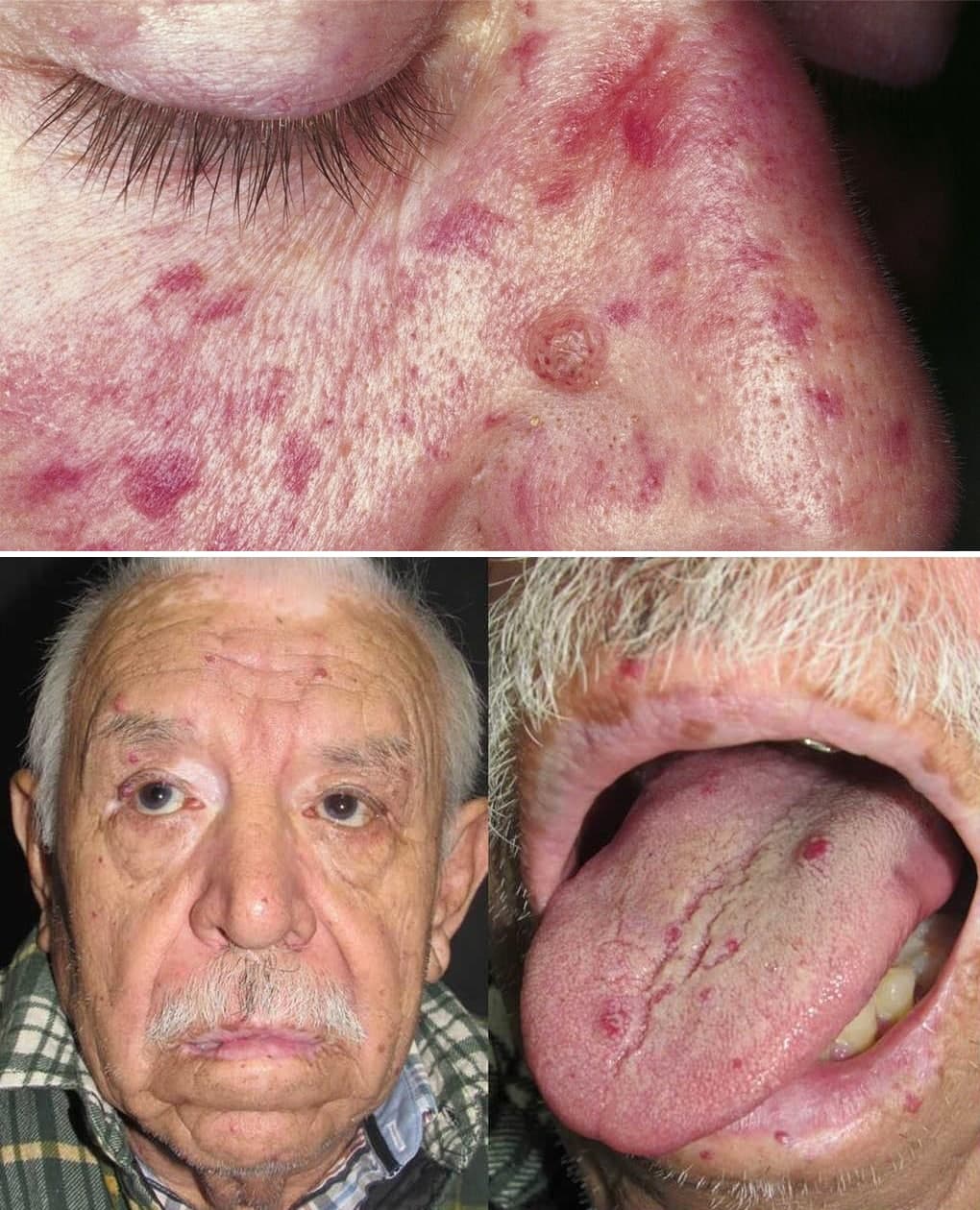 Medical Terms & Сlinical Сases Babington’s disease