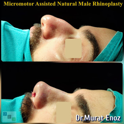 Micro-motor assisted male rhinoplasty - Nose job for men - Crooked nose aesthetic in Istanbul