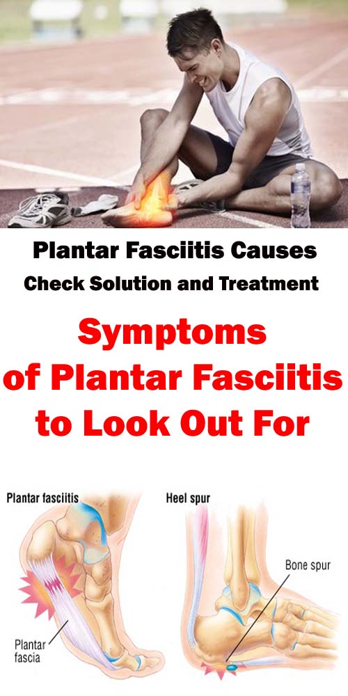 plantar fasciitis without heel pain