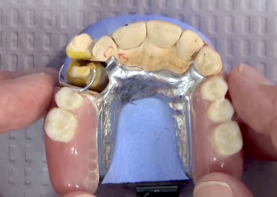 PROSTHODONTICS Creating a Crown Underneath a Partial Denture