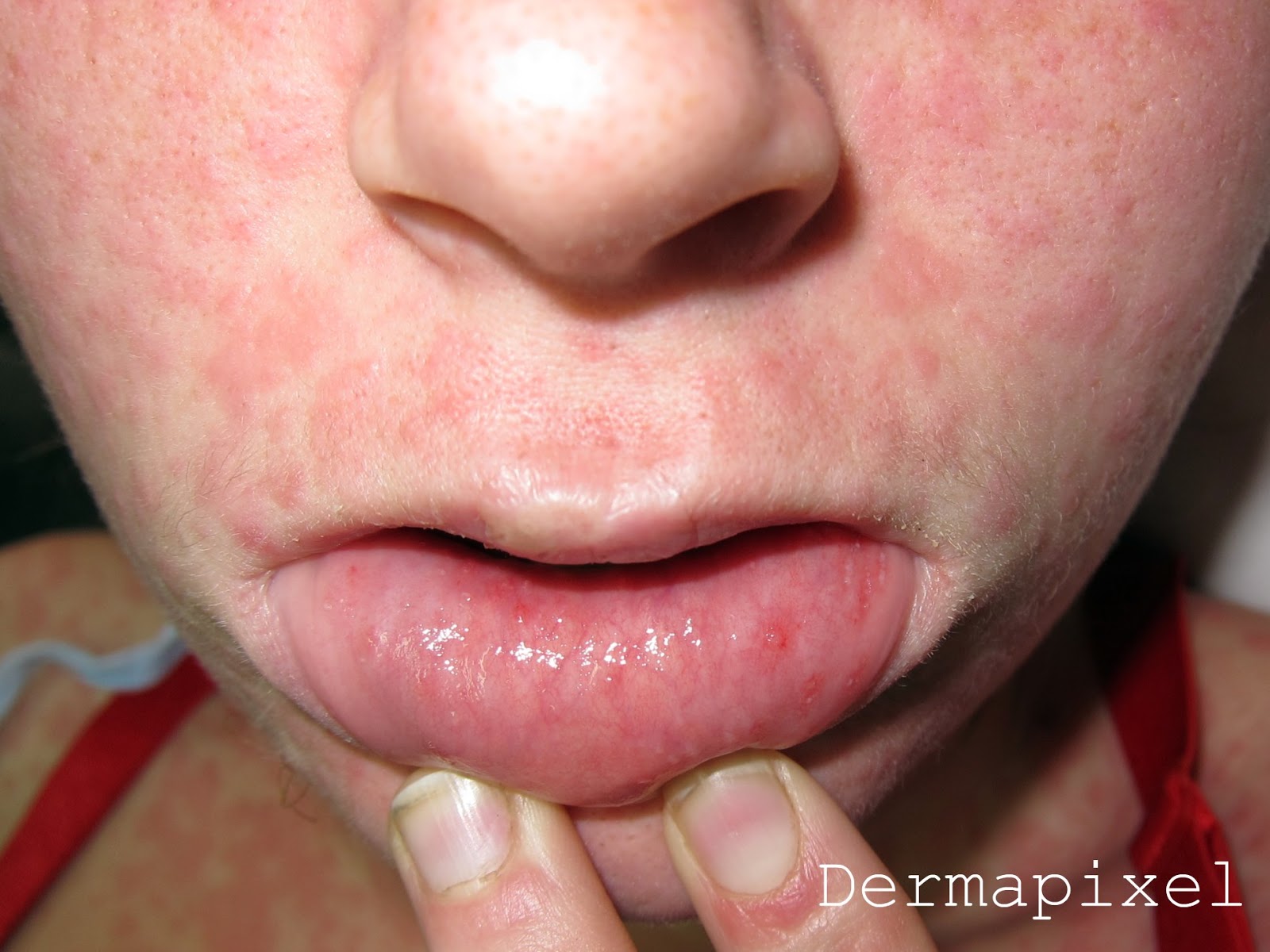 Rash on Lips - Buzzle