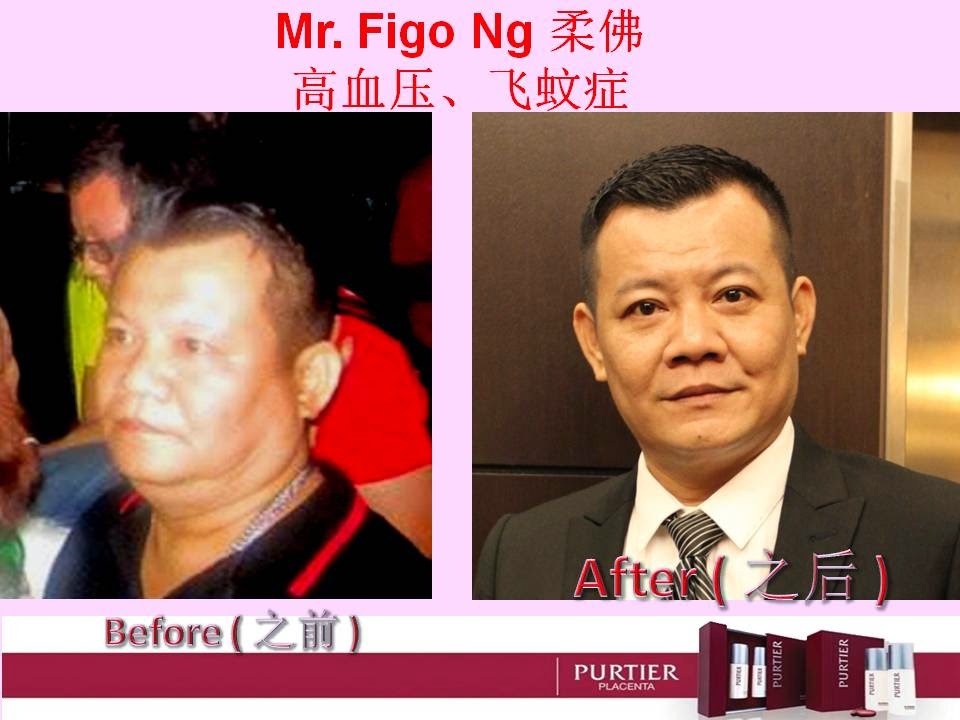 MR FIGO NG (JB) HIGH BLOOD PRESSURE (HYPERTENSION), CHORIORETINITIS