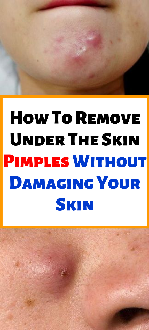 Shared Health News How To Remove Under The Skin Pimples Without