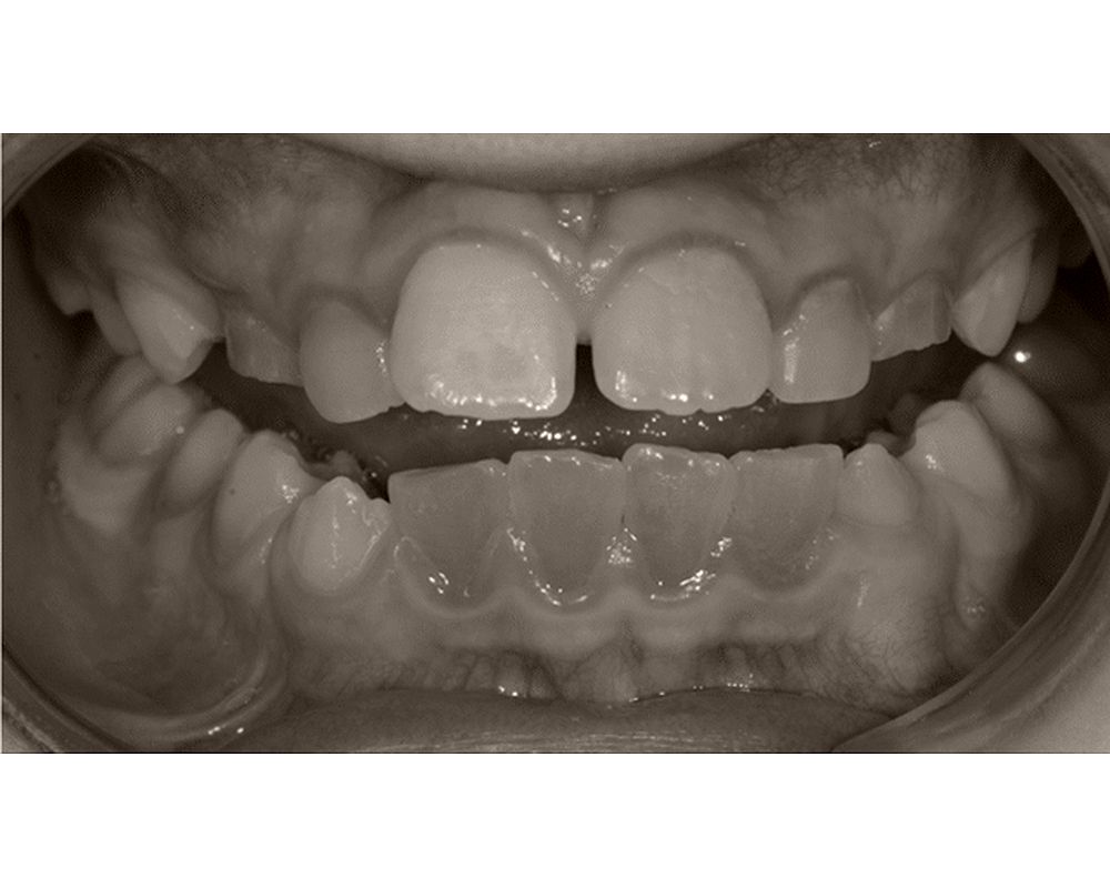 Dentinogénesis Imperfecta