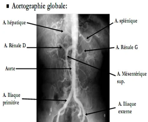 Aortographic globale