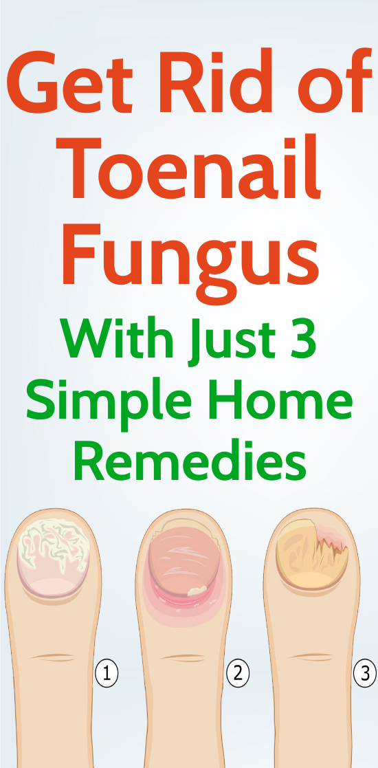 How To Get Rid Of Toenail Fungus Using Just 3 Simple Home Remedies