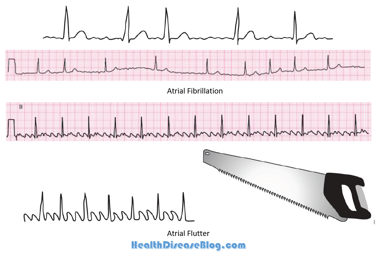 Atrial Fibrillation Vs Atrial Flutter Heart Rate Slidedocnow