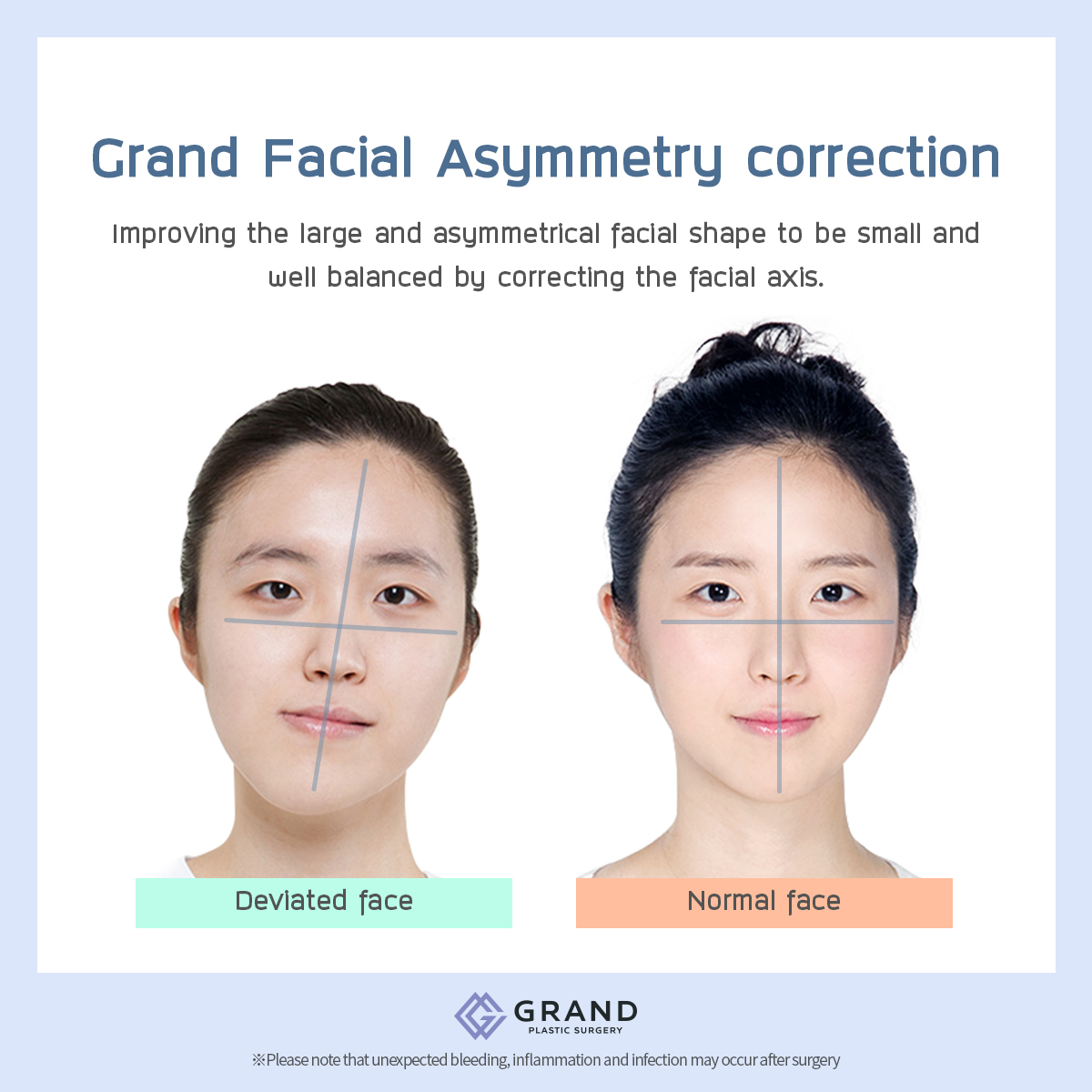 [Grand Plastic Surgery] Grand's facial asymmetry correction