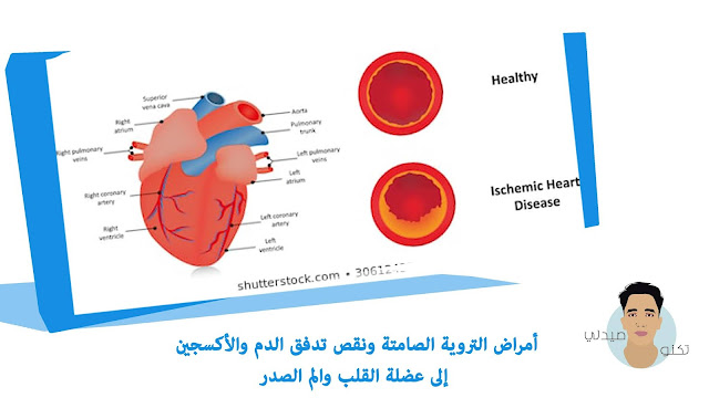 أمراض التروية الصامتة ونقص تدفق الدم والأكسجين إلى عضلة القلب والم الصدر أمراض التروية الصامتة ونقص تدفق الدم والأكسجين إلى عضلة القلب والم الصدر
