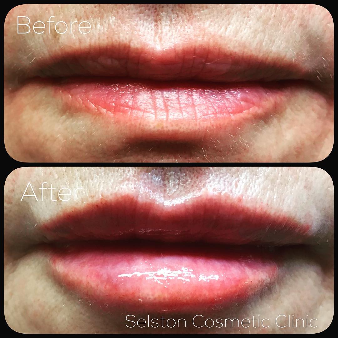 Selston Cosmetic Clinic Add Volume & Shape To The Lips With Dermal