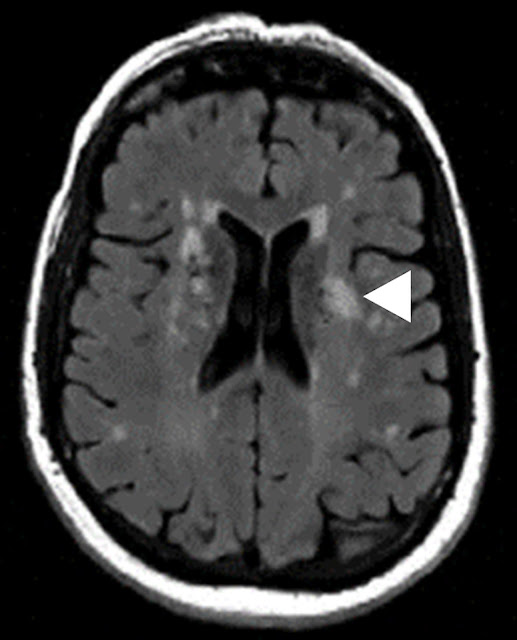 WMH-頭痛以及偏頭痛患者的腦白質病變