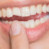 Răng sứ bị mẻ nên làm gì?