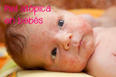 Bebés con piel atópica