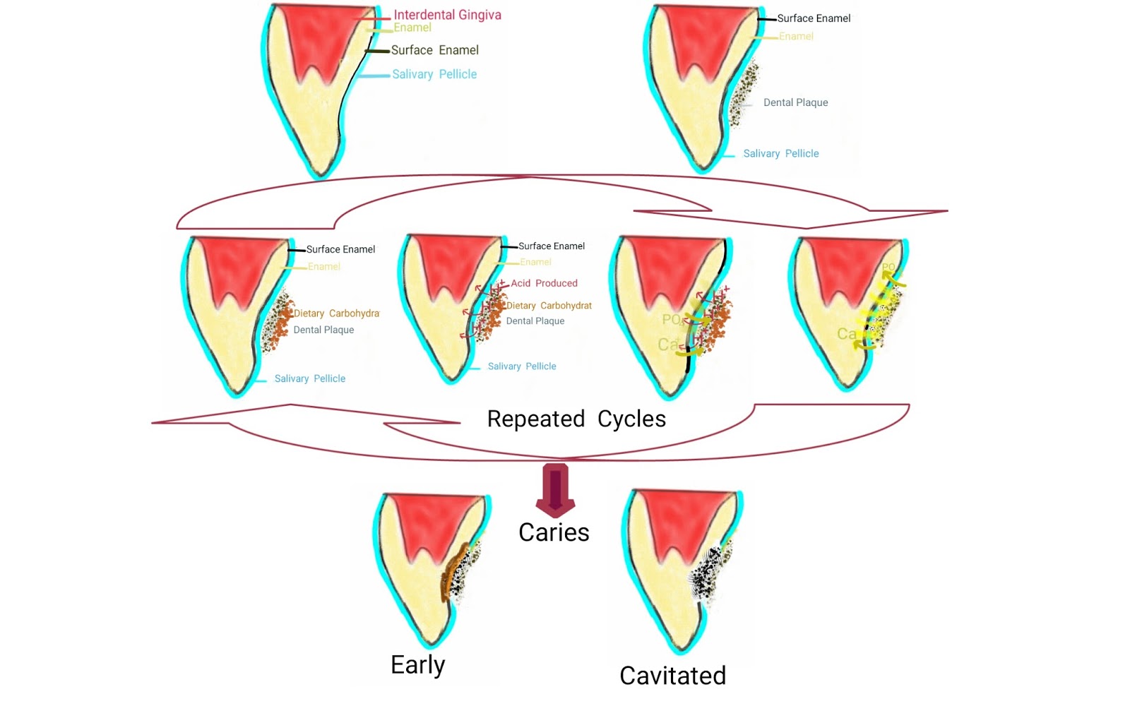 Oral Pathology India CARIES VS. EROSION