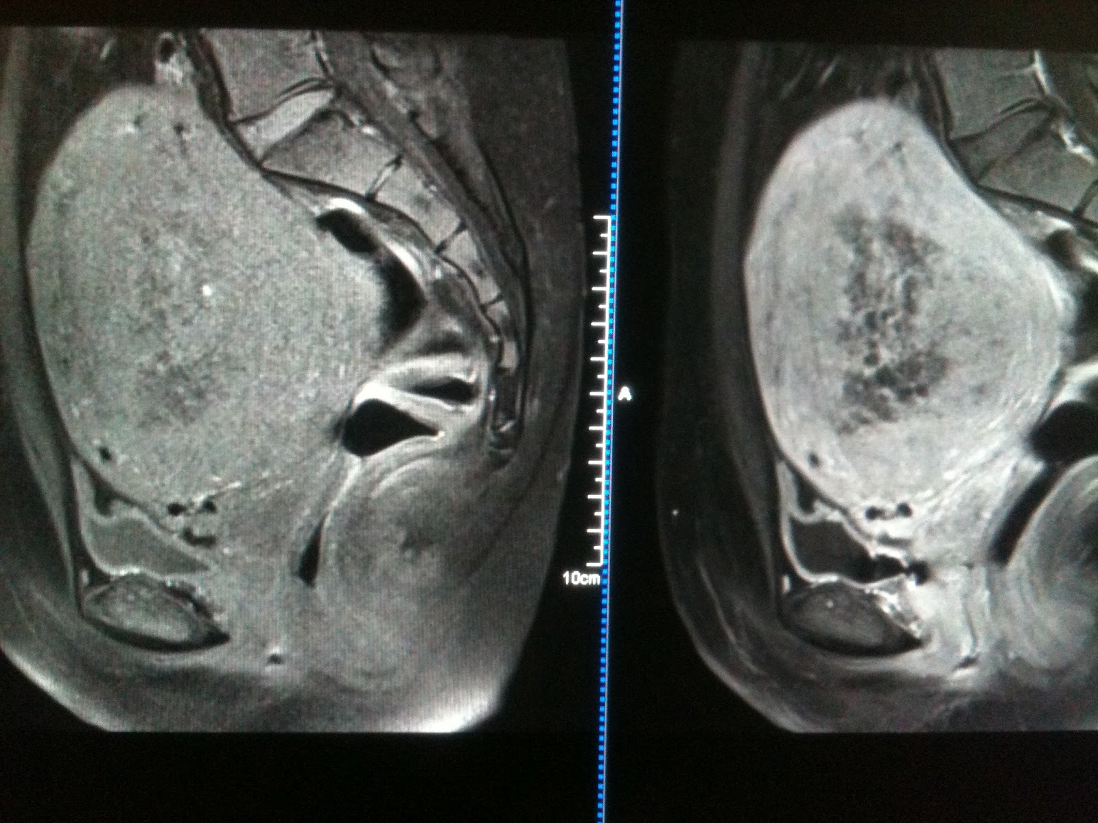 Endometrial Hyperplasia Versus Endometrial Cancer Sumer's Radiology Blog