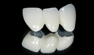 Khắc phục răng sứ bị đổi màu thế nào? 