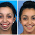 Check out before and after photos of girl after facial surgery