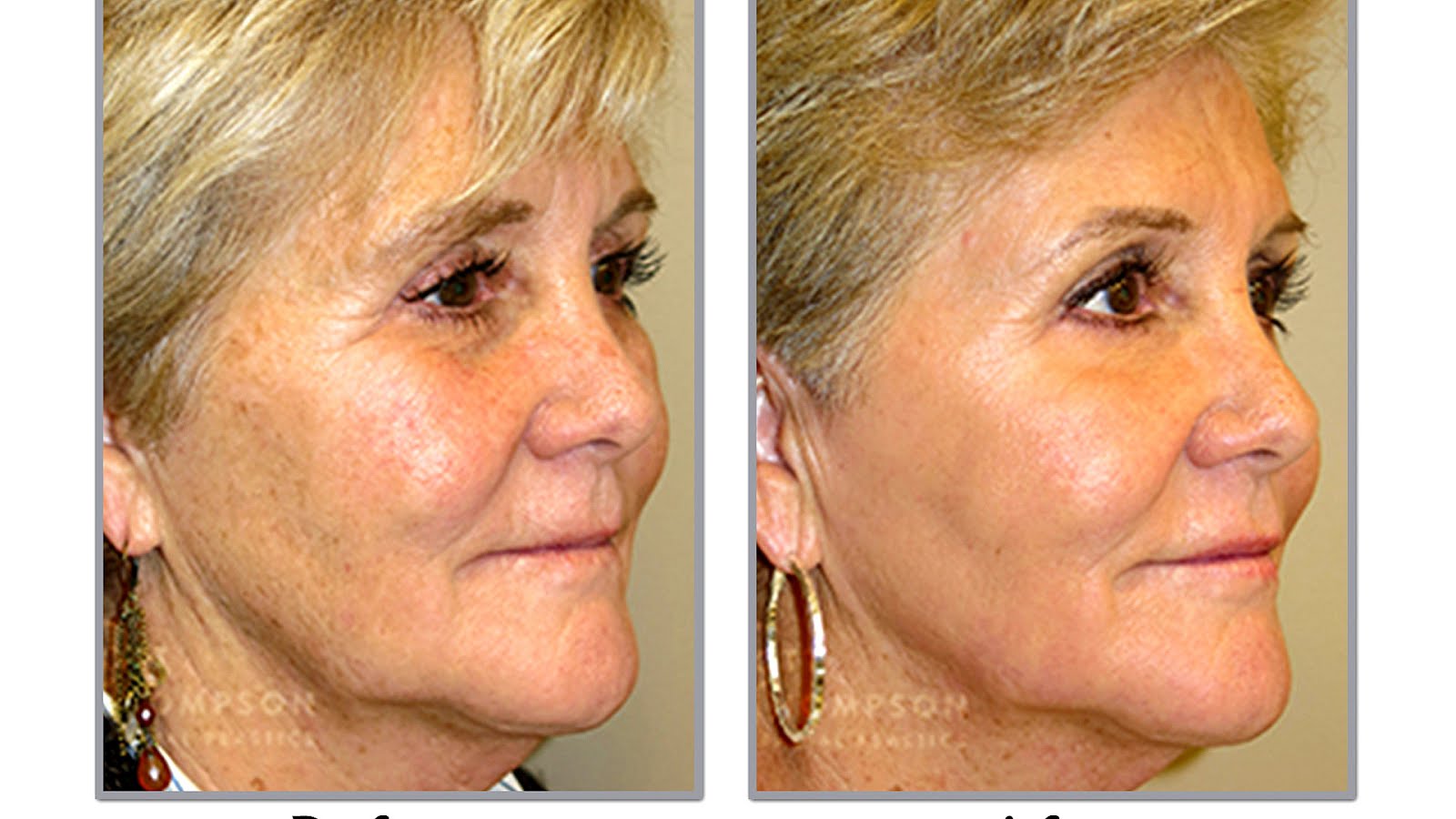Fractional Laser Skin Resurfacing Side Effects Effect Choices