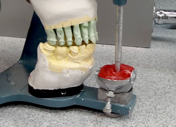 OCCLUSION: Custom Incisal Guide Table, Finale - Case ready for fabrication - (Video 3)