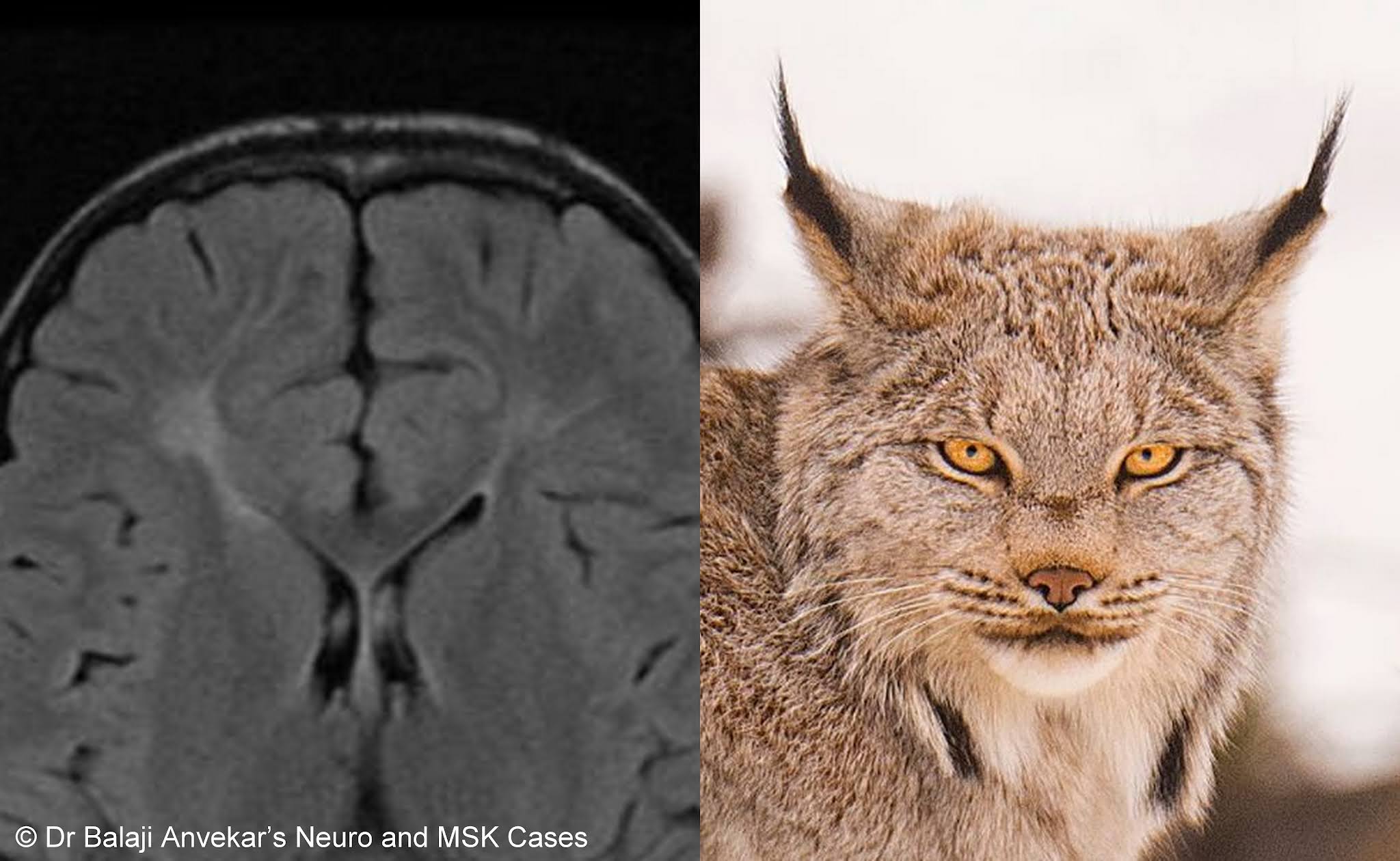 Dr Balaji Anvekar FRCR Ears of the lynx sign MRI Brain