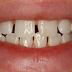 So với bọc răng sứ dán sứ veneer có bền không?