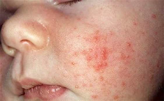 alerjik egzama dermatit niye olur