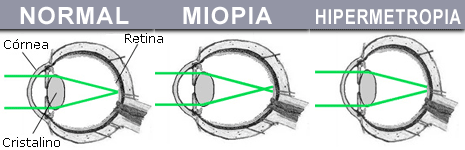 miopía astigmatismo hipermetropía presbicia