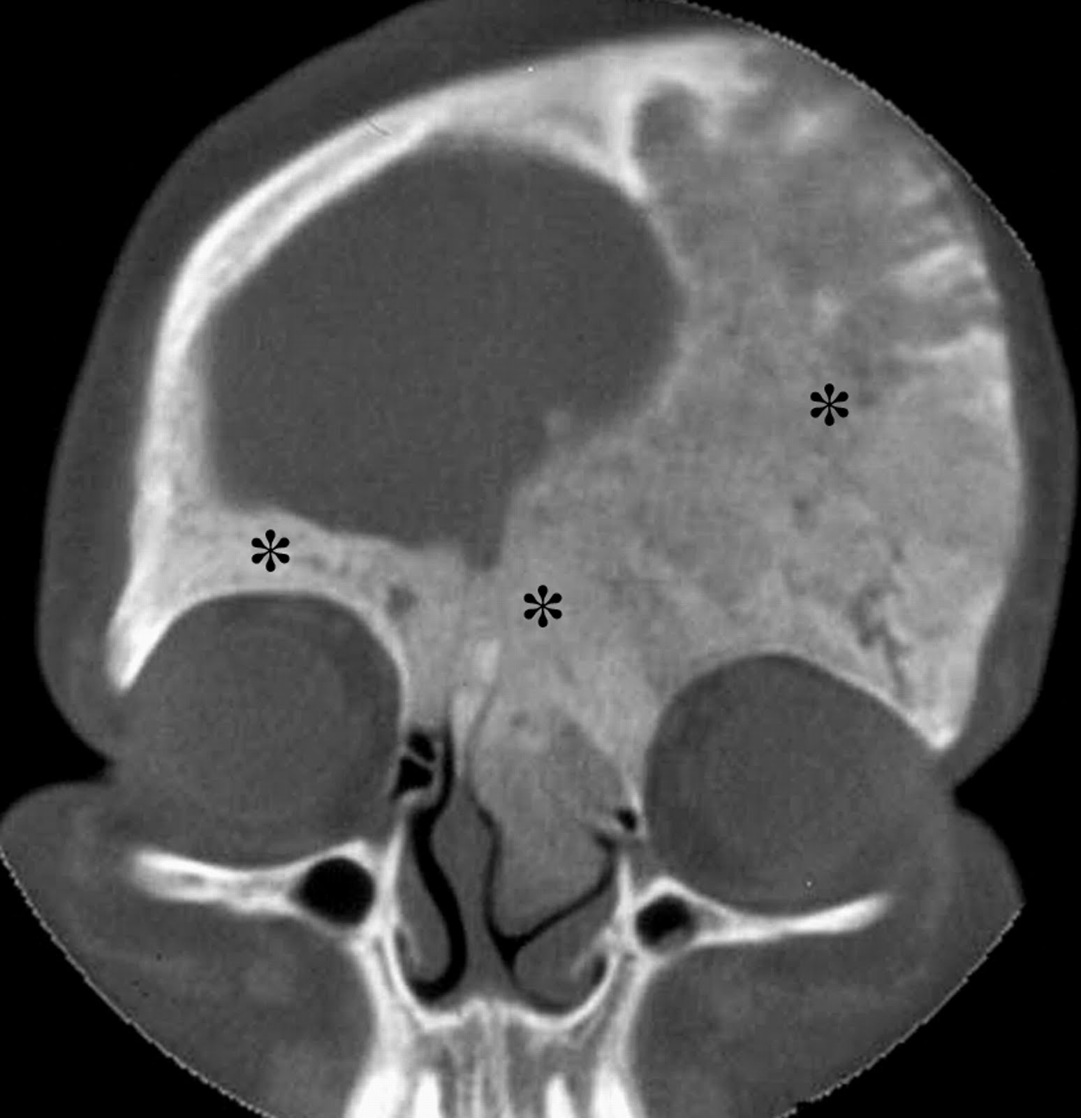Dental sky All about healthy smile Fibrous dysplasia of the bone
