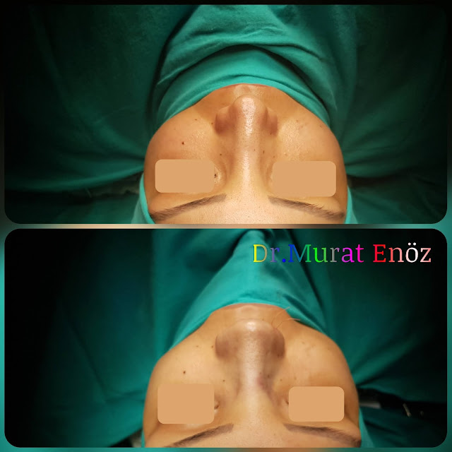 Thick Skinned Secondary Revision Rhinoplasty With Micromotor System