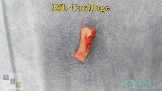 Rib Cartilage