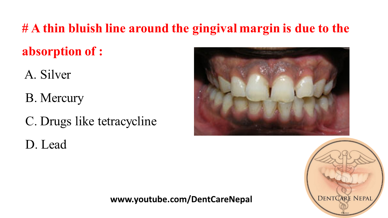 Dentosphere World of Dentistry Thin bluish line around the gingival