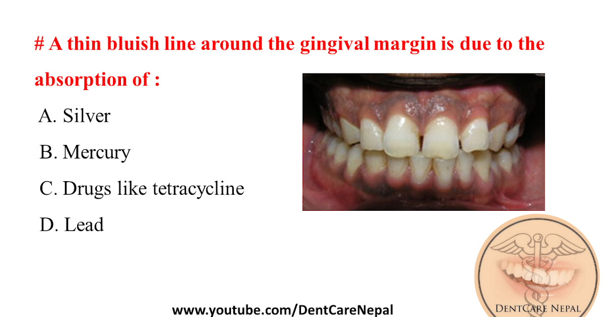 Dentosphere World of Dentistry Thin bluish line around the gingival