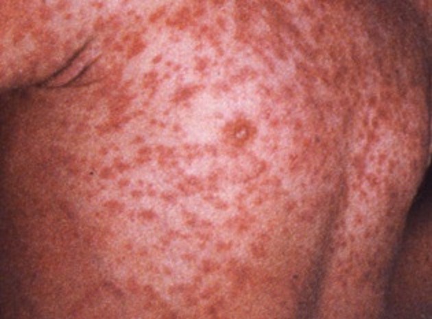 Forehead Rash - Healthgrades - Find a Doctor