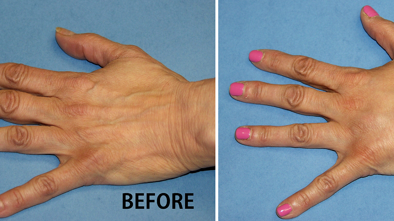 Hand Lift Surgery Lift Choices