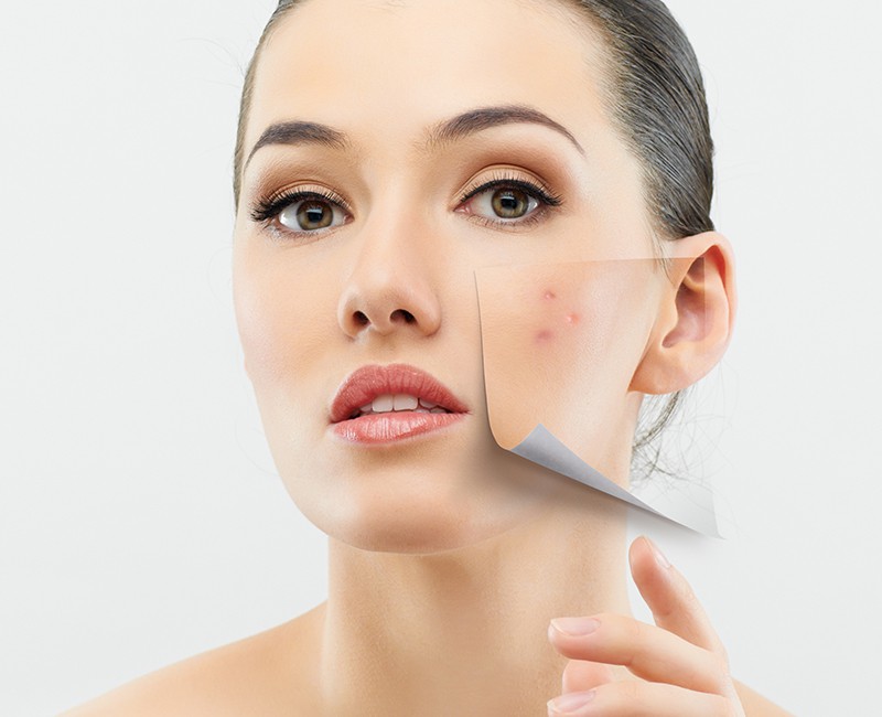 The best 10 DIY vegan acne treatments