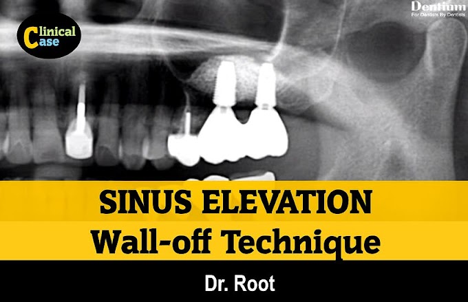 SINUS ELEVATION: Wall-off Technique - Clinical Case