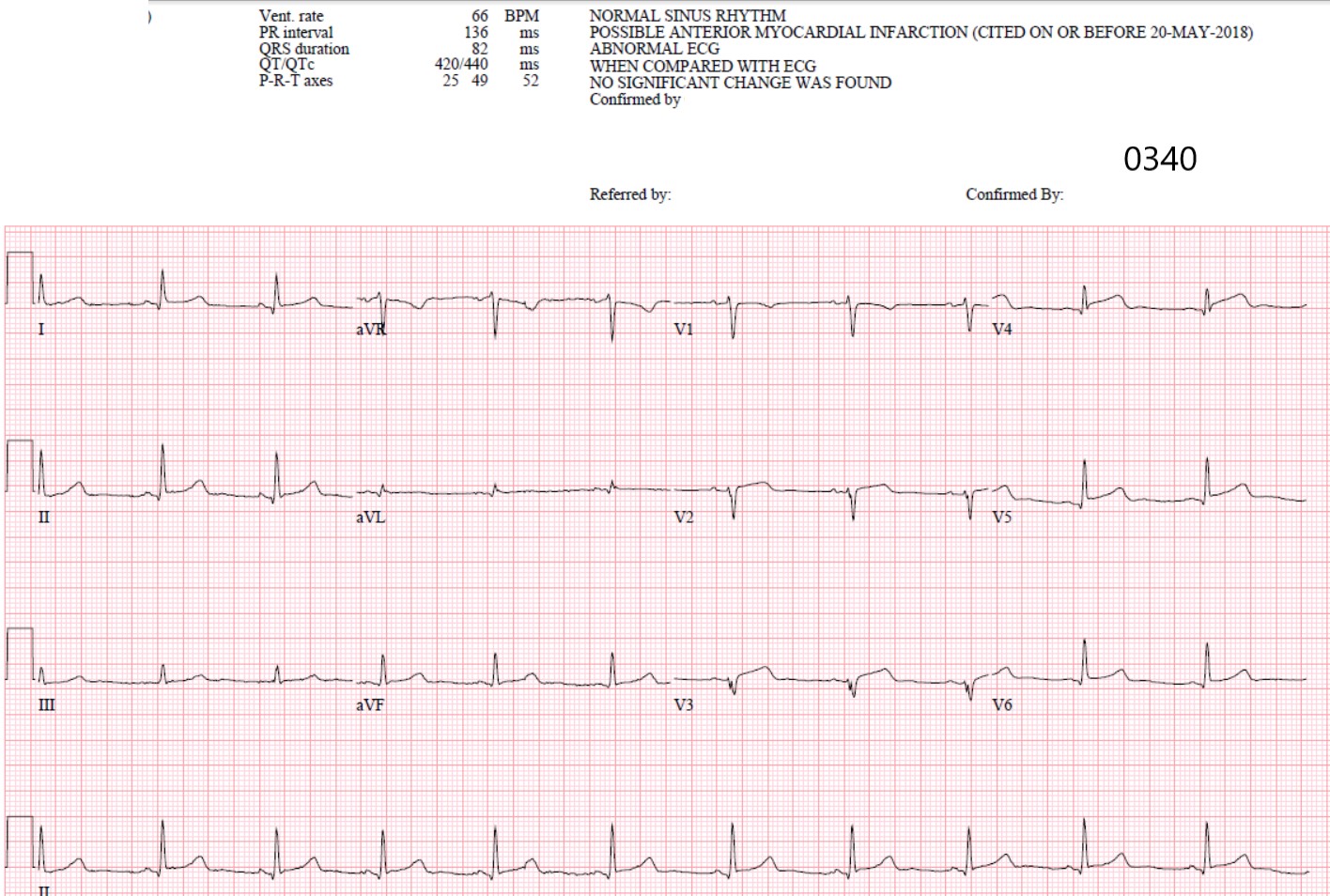 Dr. Smith's ECG Blog You Diagnose Pericarditis at your Peril (at the