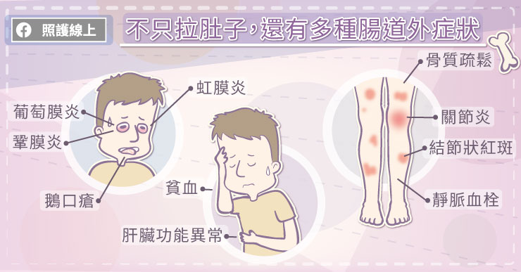 不只有腸道!克隆氏症還可能有多種腸道外症狀