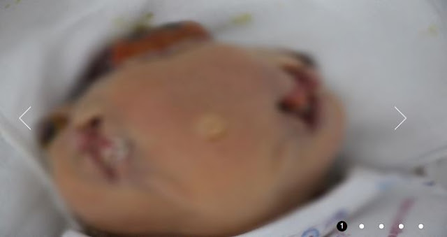 ولادة رضيع سوري بأربع عيون وفمين اثنين 