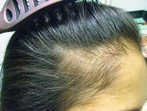 alopecia traction regrowth