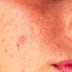 طرق علاج حب الشباب الهرموني hormonal acne treatment طرق علاج حب الشباب الهرموني hormonal acne treatment