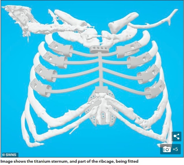 Grandmother, 52, is one of the first people in the world to have a 3D-printed sternum fitted