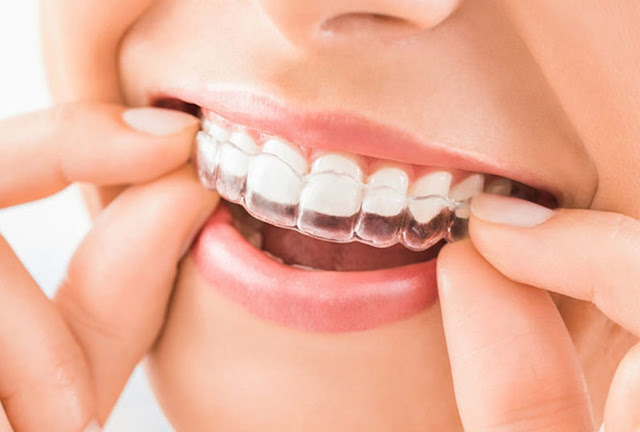 dental health, dental health tips, health, dental bonding, teeth, teeth whitening, invisible aligners, cosmetic dentistry
